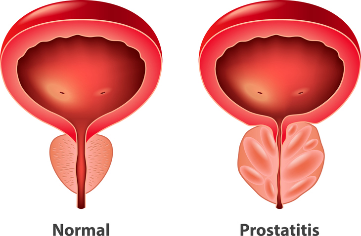 Prostatitis